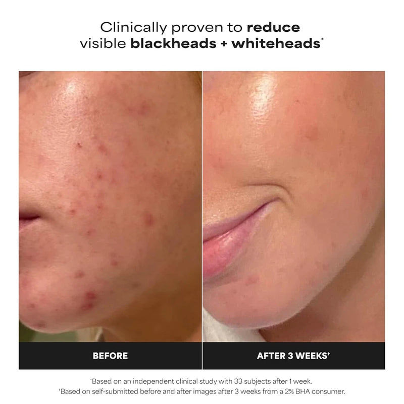 Paulas Choice Skin Perfecting 2 Percent BHA Liquid Exfoliant