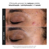 Paulas Choice Skin Perfecting 2 Percent BHA Liquid Exfoliant