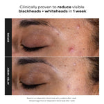 Paulas Choice Skin Perfecting 2 Percent BHA Liquid Exfoliant