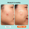 TKTK Hydrocolloid Pimple Patches